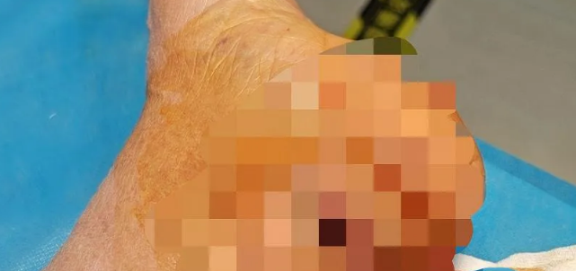 事发莆田一小区，流浪狗半个月内咬了3人！街道已介入