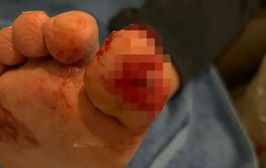 男子睡梦中被爱犬咬掉一根脚趾，却因祸得福？