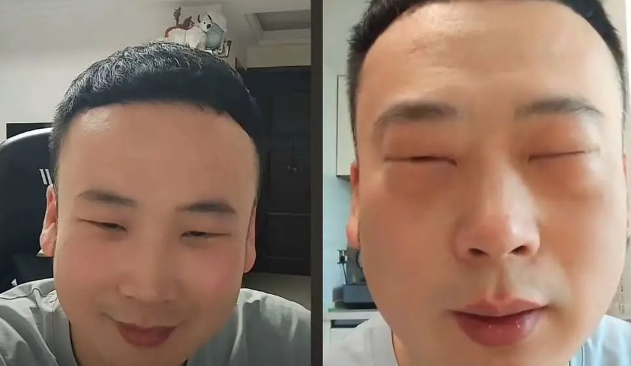 男子吃蚕蛹后肿成奥特曼，当事人：吃蝎子蜈蚣都没事