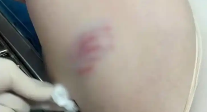 孕妇骑车被三只狗追咬，打狂犬疫苗后胎儿停止发育