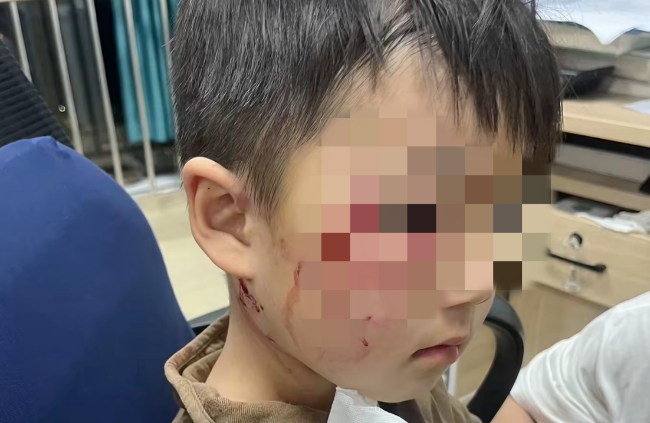 3岁男童被狗咬伤去世 接种狂犬病疫苗为何还会病发？