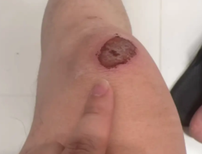 男子膝盖受伤了，猫咪几次跳起来踩他的伤口