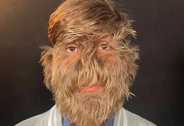 18岁男孩患罕见“狼人综合征”，毛发覆盖面部