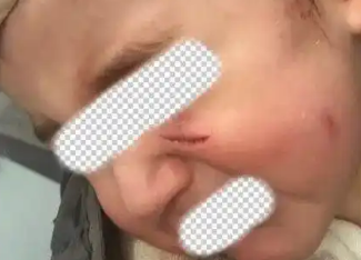 1岁萌娃突遭宠物狗扑咬！头面部多处撕裂紧急送医