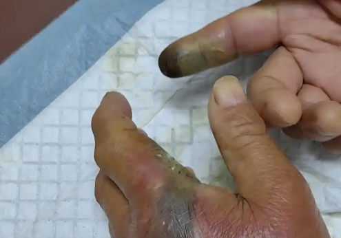 男子被毒蛇咬伤，忍痛去抓又来一口