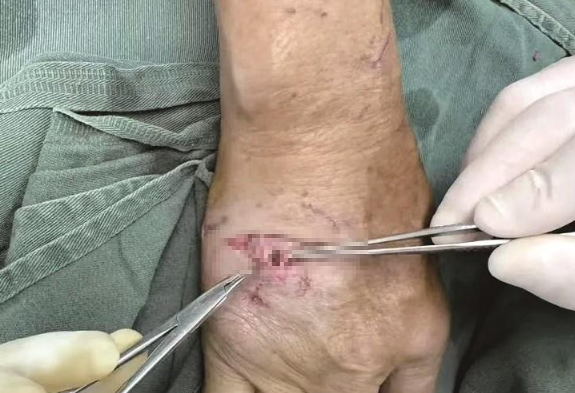 女子被野猫袭击，手背肌腱被咬断裂